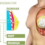 Treatment of gynecomastia