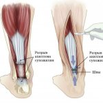 Surgical treatment of tendon rupture
