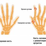 Rheumatoid arthritis.jpg